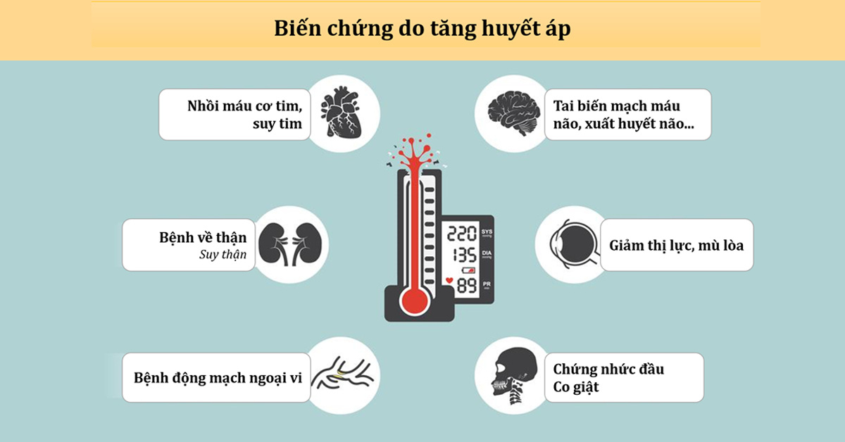 Cao Huyết Áp Dẫn Đến Tai Biến Mạch Máu Não: Hiểu Biết và Hành Động Đúng Cách